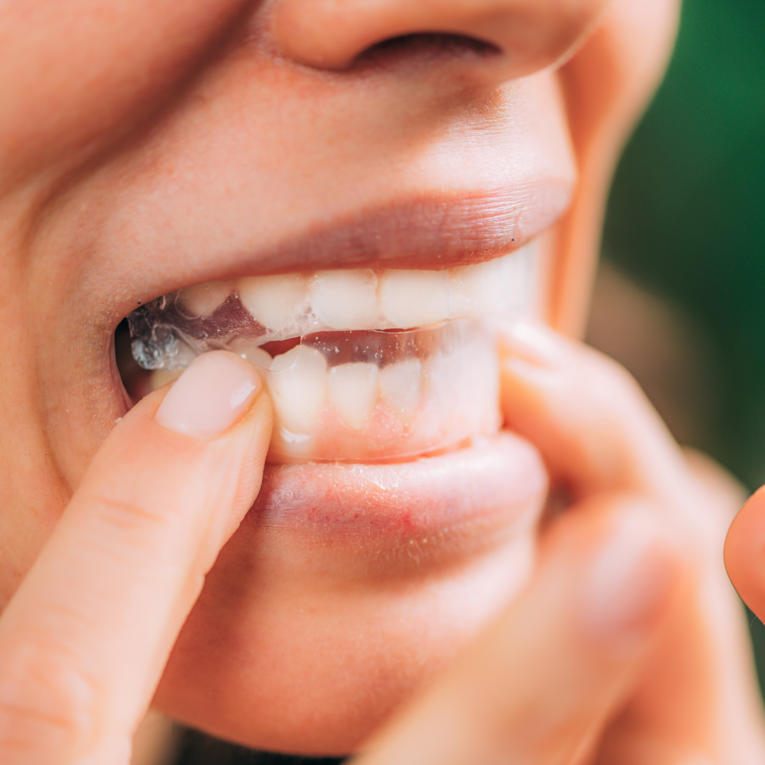 peroxide free teeth whitening strips