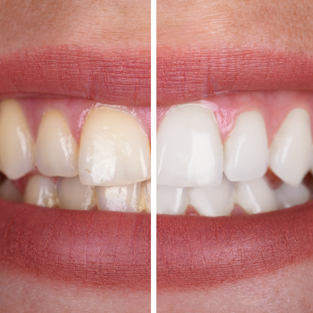 dentist-approved whitening strips UK