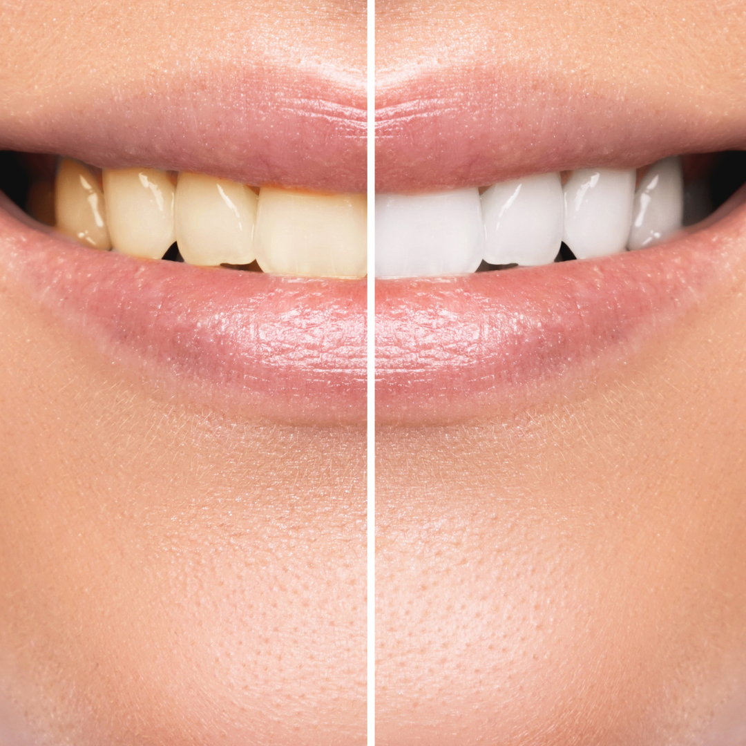 Teeth before and after using whitening strips